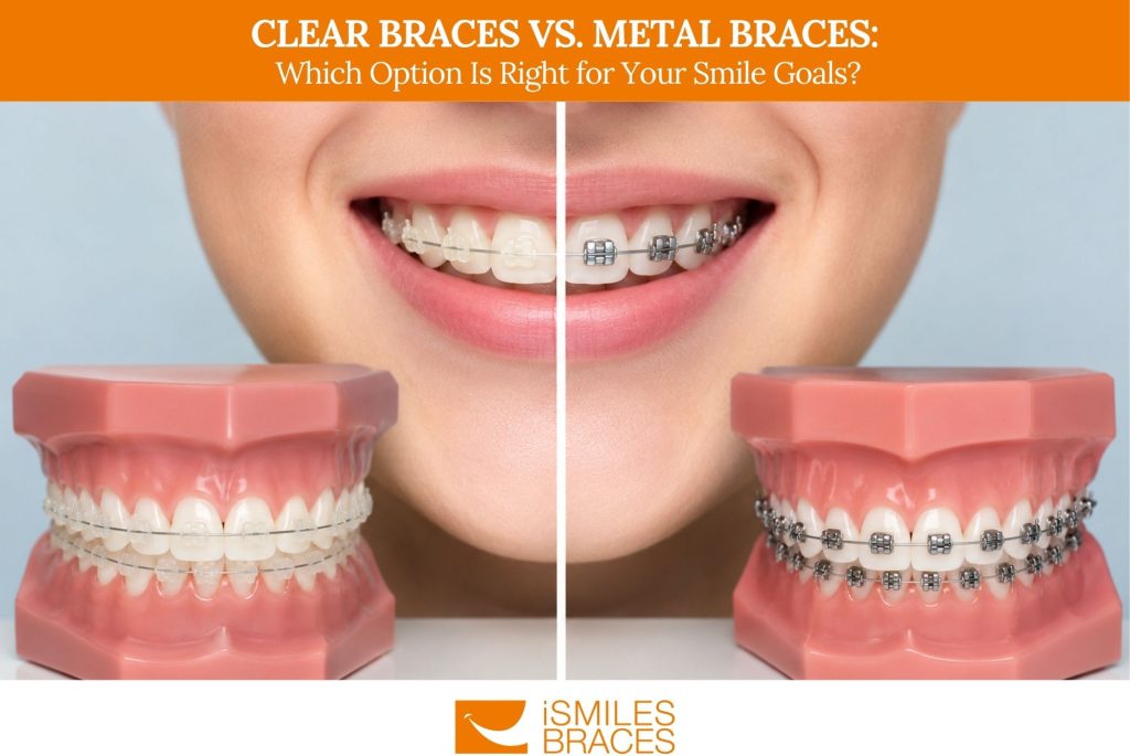 Clear Braces vs. Metal Braces Which Option Is Right for Your Smile Goals