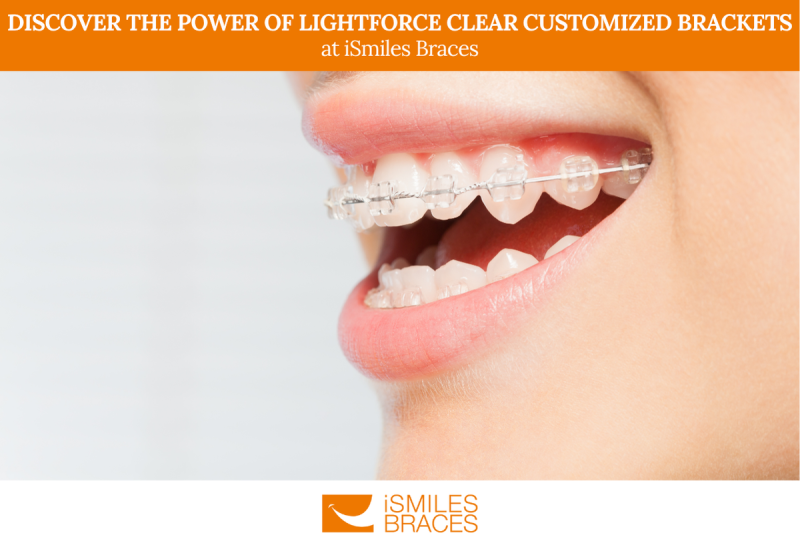 Discover the Power of LightForce Clear Customized Brackets at iSmiles Braces